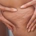 Why Is Cellulite So Dang Hard to Get Rid of?