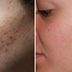 The Best Acne Scar Treatment for Even the Toughest Scars