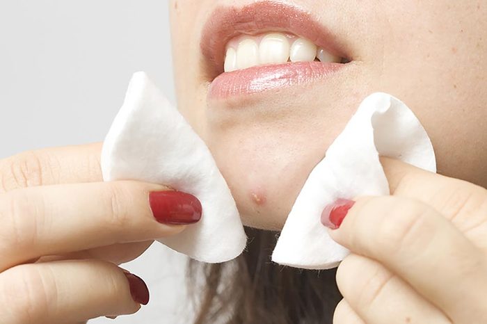 Woman cleaning a zit on her face with acne pads.