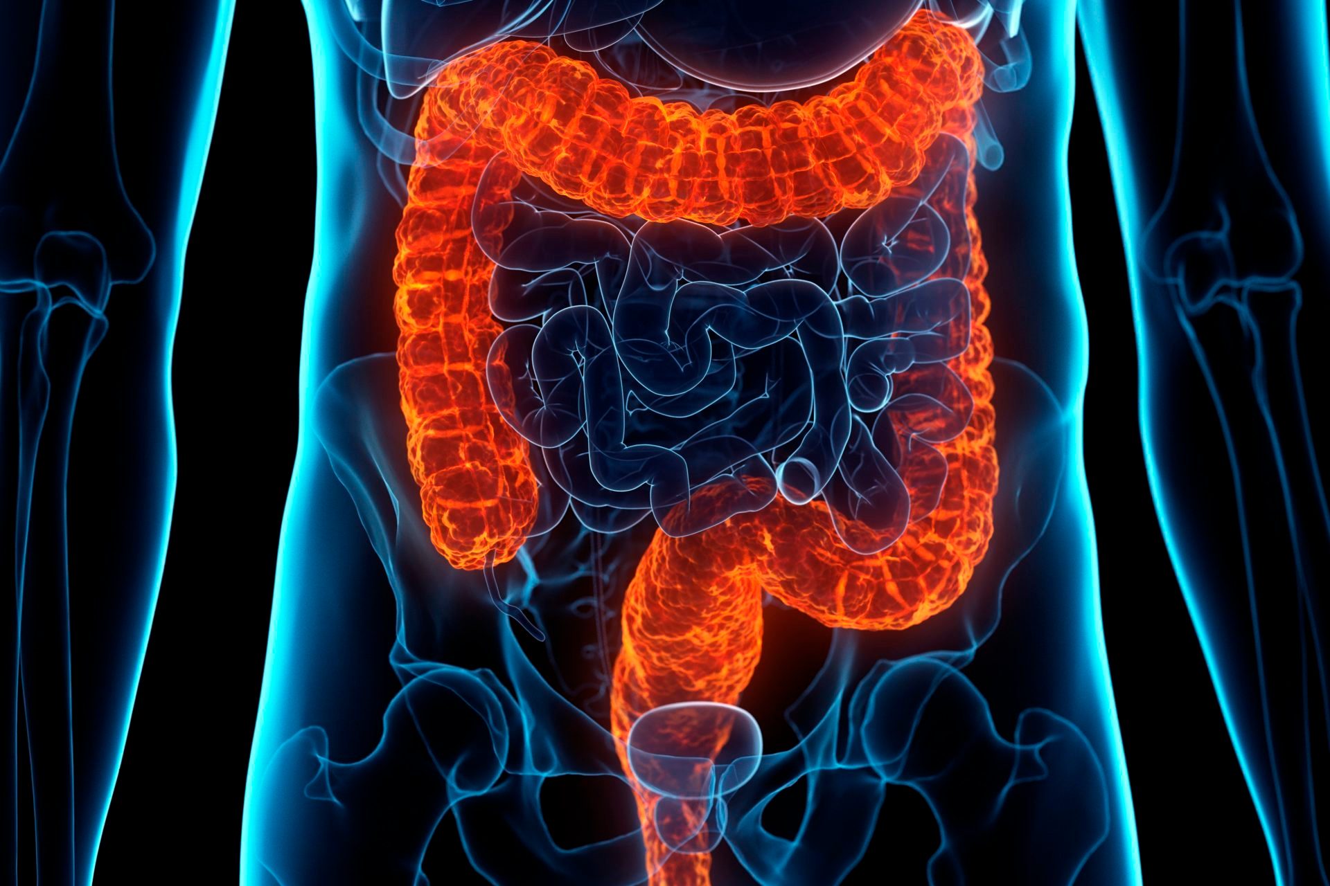 Diseased Colon, Conceptual Illustration